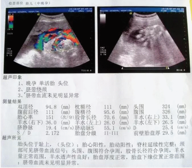 怀孕b超单图片